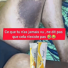 Fevicid Crème – Anti-Mycoses, Tâches Noires et Boutons de Rasage